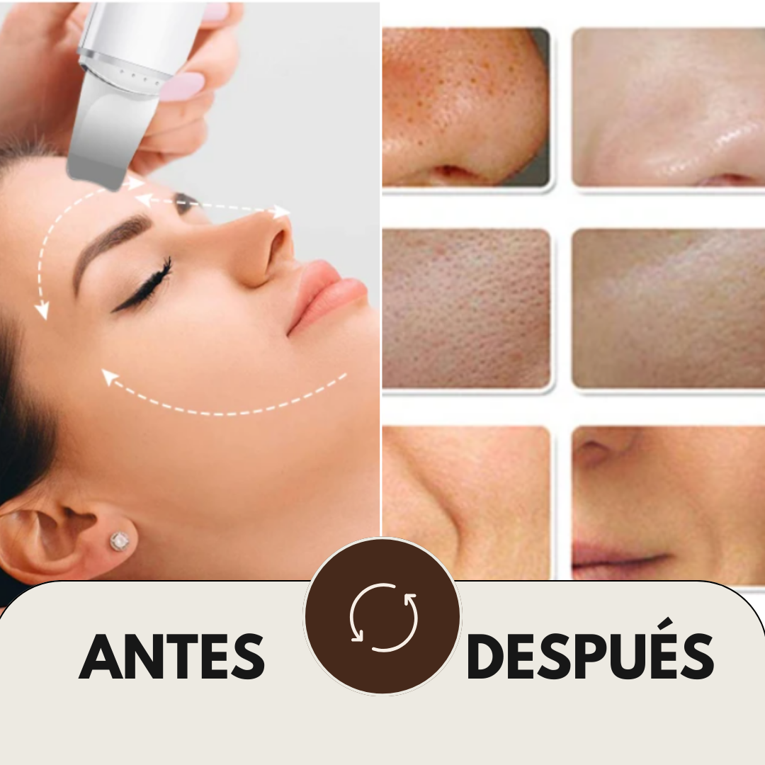 RadiancePro™️ Limpiador Facial Ultrasonido